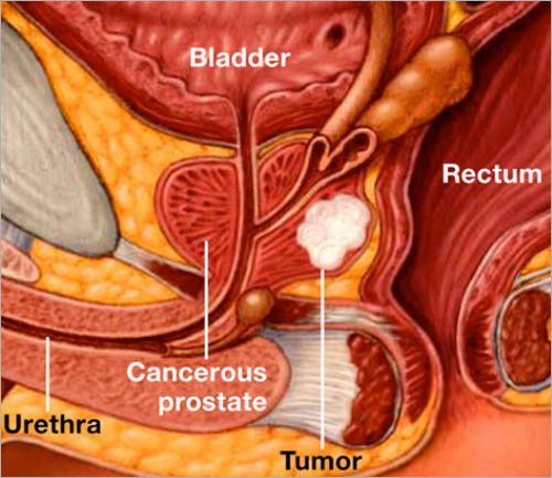 Carcinoma della prostata