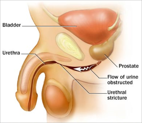 Stenosi dell’uretra