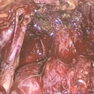 Prostatectomia radicale laparoscopica