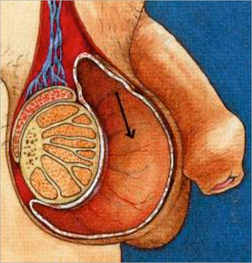 Idrocele