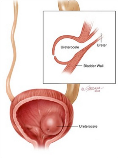 Ureterocele