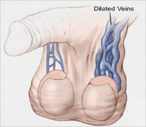 Varicocele